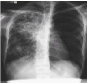 Gambar 7. Foto Toraks Tuberkulosis Paru 