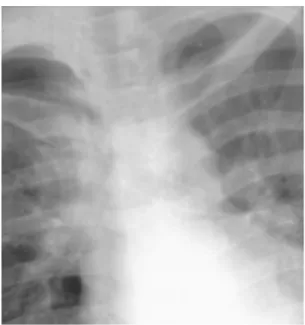 Gambar axial CT Scan menunjukkan udara mengelilingi aorta desenden (kepala panah hitam), vena azygos (panah putih), esofagus (panah hitam), dan bagian depan tulang belakang (dua panah
