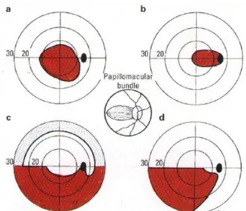 Gambar 6. Defek lapangan pandang pada penyakit nervus optik (a) skotoma sentral, (b) skotoma cecosentral (c) nerve fiber bundle (d) altitudinal