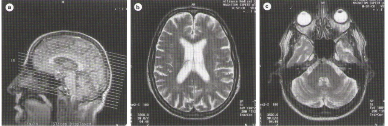 Gambar 9. Potongan aksial orbita dan otak pada  MRI scan . Pemeriksaan Elektrofisiologi
