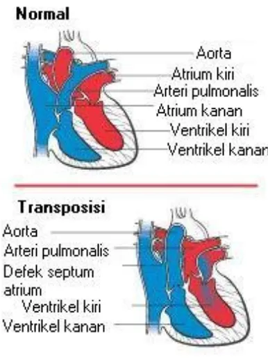 Gambar 1.Transposisi Arteri Besar(2) 