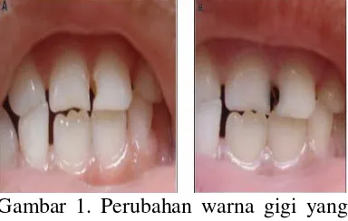 Gambar 1. Perubahan warna gigi yang terjadi  setelah aplikasi SDF (sumber : Richard Niederman  2010) 