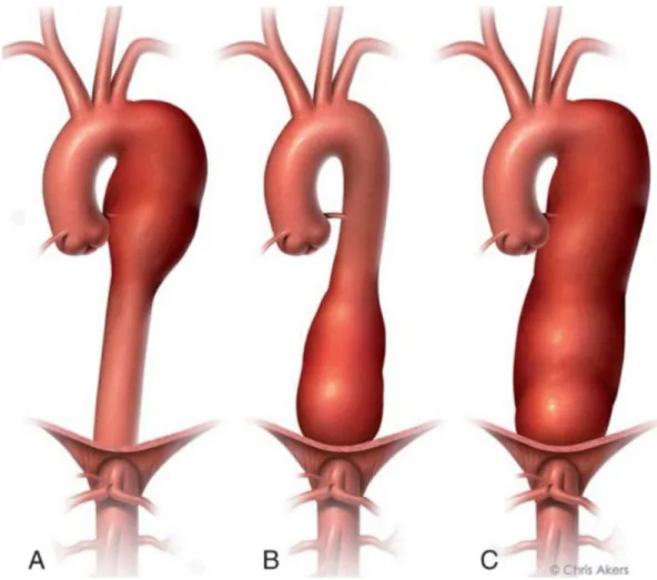 Gambar 2. Tipe Aneurisma torasika desenden. A) distal arteri subklavia kiri sampai sela iga enam; B) sela iga enam sampai dibawah diafragma; C) seluruh aorta desenden