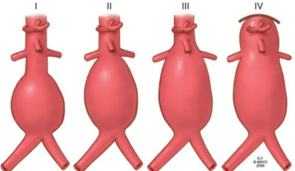 Gambar 3. Tipe aneurisma aorta abdominal. I) Infrarenalis; II) Juxtarenalis; III) Pararenalis; IV) Suprarenalis