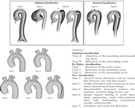 Gambar 5. Klasifikasi diseksi aorta