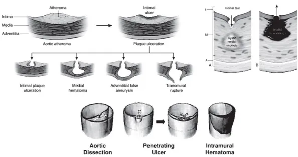 Gambar 6. Proses disekan pada dinding aorta