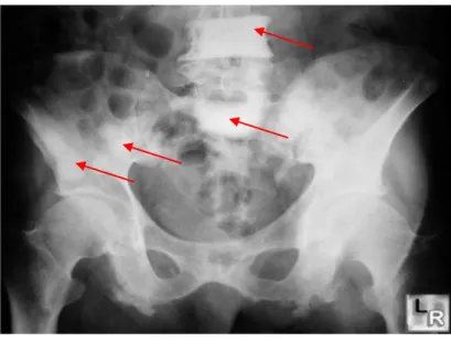 Gambar 4 : Foto polos lumbal dan pelvis. Tampak gambaran osteoblastik  multipel pada os