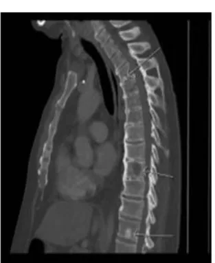 Gambar  10.    CT  –scan  thorax  potongan  sagital.  Tampak  gambaran    osteoblastik  dan  osteolitik  pada  vertebra  thorakalis  seorang  penderita Ca