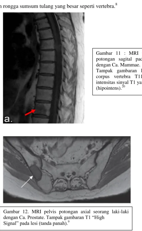 Gambar  11  :  MRI  thorakalis  potongan  sagital  pada  pasein  dengan Ca. Mammae.  