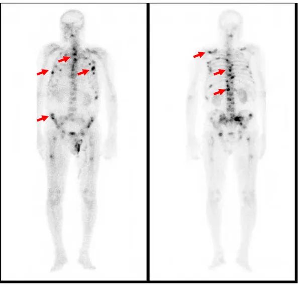 Gambar 13 : 99mTc bone scintigraphy pada pasien dengan Ca. Prostate Tampak  gambaran “hot lesion” pada tulang-tulang axial yang menunjukkan adanya  metastasis tulang pada tulang tersebut