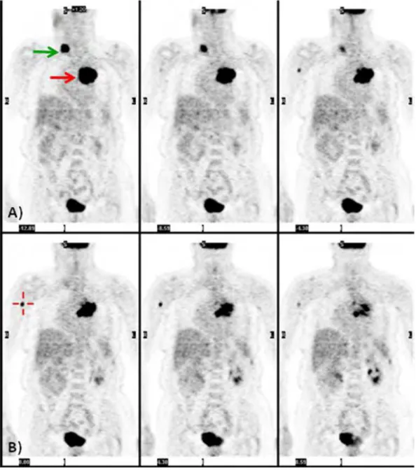 Gambar 14 . PET scan pada pasien dengan Ca. Paru. (A) 18FDG PET menunjukkan  tumor  primer  (panah  merah)  dengan  metastasis  pada  limfonodul  clavicula  kontralateral  (panah  hijau)