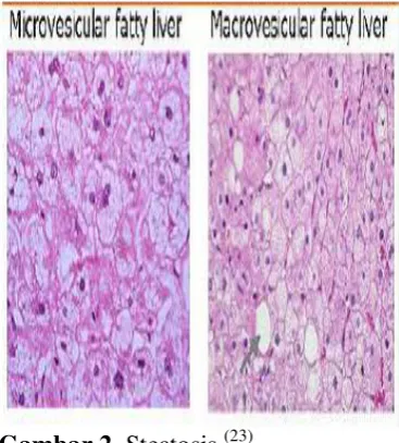 Gambar 3. Steatohepatitis.(23)  