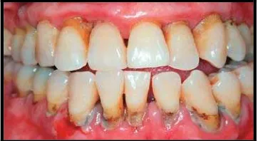 Gambar 3. Gambaran klinis periodontitis kronis16 
