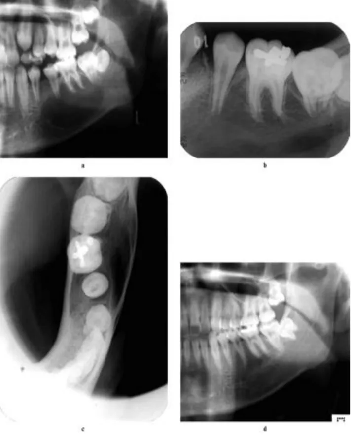 Gambar 1.  (a) Kista tulang sederhana dengan batas mulus. (b) radiografi temuan dengan lamina dura yang utuh