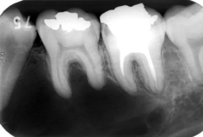 Gambar 3 kista tulang sederhana dengan resorpsi  akar gigi molar pertama . Septum-seperti garis  radiopak juga terlihat (panah)