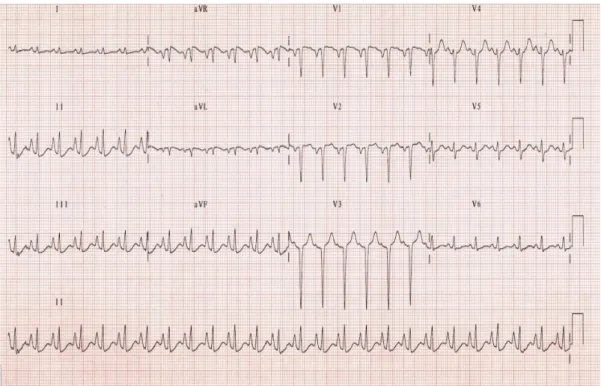 Gambar 4.4. Gambaran EKG PPOK 19 3.  Analisis gas darah