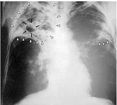 Gambar 2.2 Gambaran rontgen penderita TB paru 