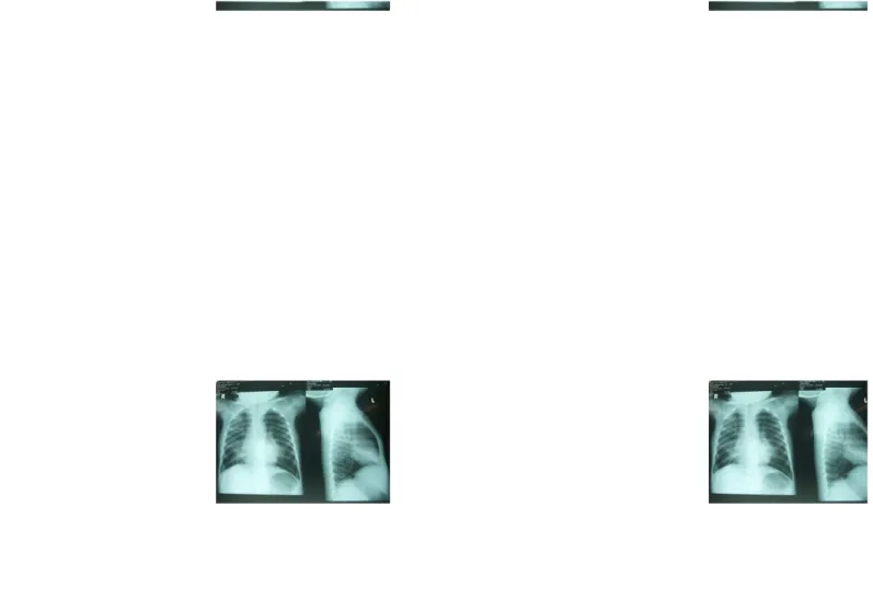 Gambar 3: rontgen thorax pasien dengan pneumonia aspirasi paru-paru kiri