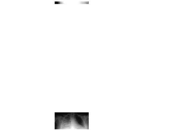 Gambar  4:  rontgen  thorax  pasien  dengan  aspirasi  masif  pada  paru-paru kanan.