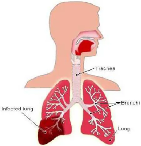 Gambar 1: paru-paru yang mengalami infeksi