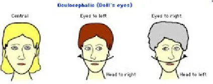 Gambar 5. Doll’s eye movement