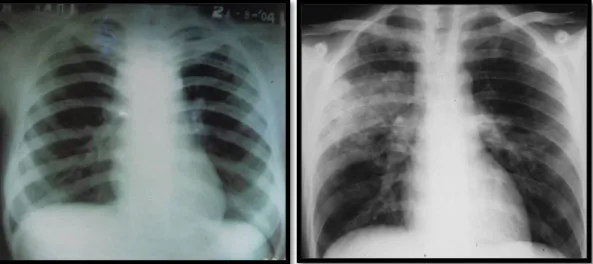 Gambar  2.7.  Konsolidasi  lobus  kanan  atas,    bagian  kiri  tengah  dan  adenopati  pada penderita TB-HIV  