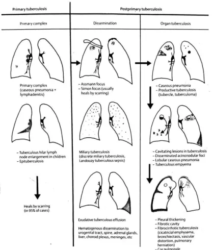 Gambar 6: Patogenesis TB primer dan TB post primer secara gambaran radiologi. 20 