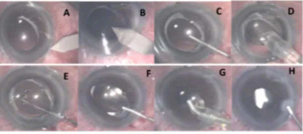 Gambar  1.  Pemasangan  LIO  piggyback  sekunder:  (A)  insisi  2.75mm  pada  kornea  menggunakan  keratom;  (B)  penembusan  BMD  dengan  keratom;  (C)  injeksi  viscoelastic  untuk  memperdalam BMD dan area antara kapsul anterior  lensa  dengan  permukaa