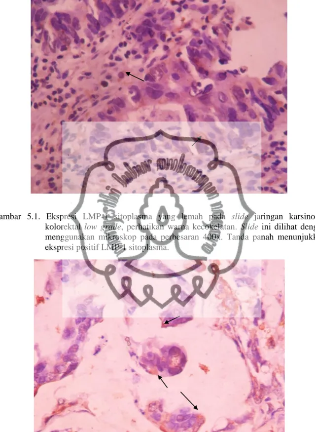Gambar  5.1.  Ekspresi  LMP-1  sitoplasma  yang  lemah  pada  slide  jaringan  karsinoma  kolorektal  low  grade,  perhatikan  warna  kecokelatan