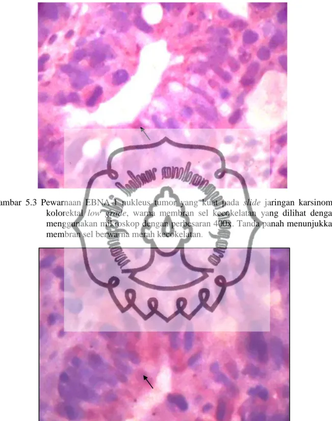 Gambar  5.3  Pewarnaan  EBNA-1  nukleus  tumor  yang  kuat  pada  slide  jaringan  karsinoma  kolorektal  low  grade,  warna  membran  sel  kecokelatan  yang  dilihat  dengan  menggunakan mikroskop dengan perbesaran 400x
