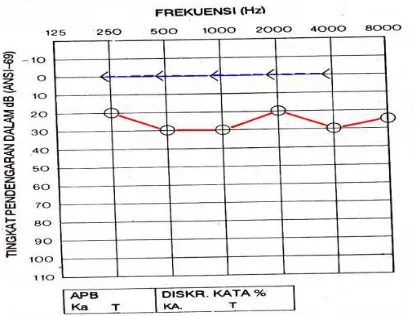 Gambar 2.7. Gambaran audiogram gangguan pendengaran konduktif (Arini, 