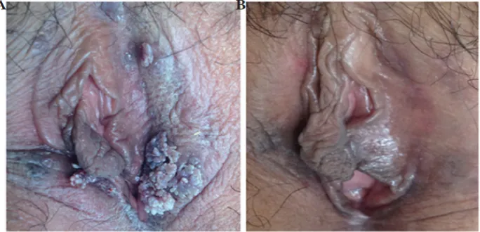 Gambar 1. Lesi pada kasus 1. (A) Sebelum pengobatan dan (B) setelah pengobatandengan cryotherapy dan proanthocyanidins.