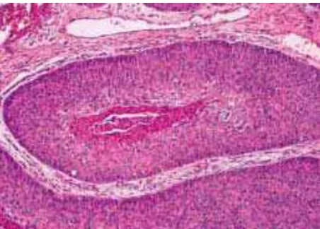Gambar 2.4 Squamous cell carcinoma ( dikutip dari Eble et al, 2004) 