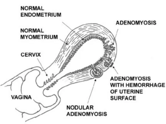 Gambar 2.7 Adenomiosis (Dikutip dari Clinical Gynecologyc Oncology, 2007) 