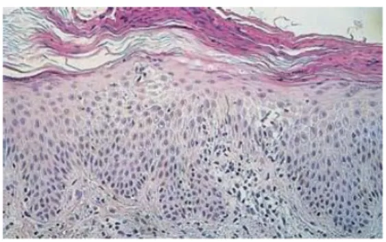 Gambar histologik non spesifik tipikal dari Pitiriasis Rosea, menunjukkan parakeratosis, hilangnya lapisan granular, akantosis ringan, 