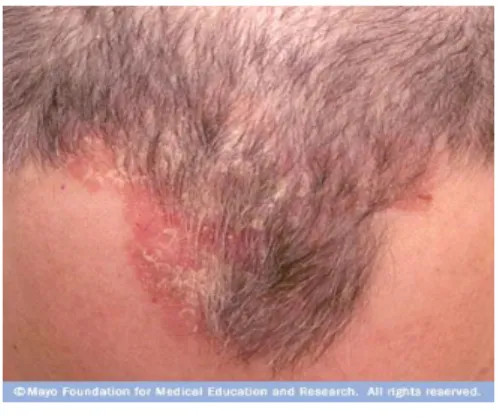 Gambar 6. Scalp Psoriasis 