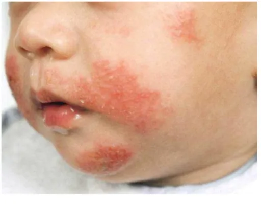 Gambar 7. Dermatitis Atopik 