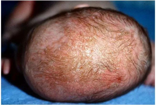 Gambar 1. Dermatitis Seboroik Infantil 