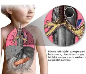 Gambar 3: Kistik Fibrosis 1 