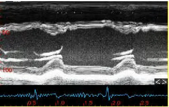 Gambar 1 Pencitraan ventrikel kiri melalui M-mode (Stoylen 2006)