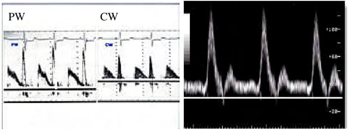 Gambar 3 Pencitraan pulsed wave Doppler (Anonim 2002)