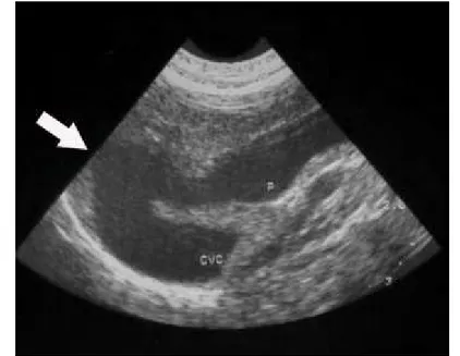 Gambar 5 Pencitran USG pada kasus intrahepatik shunt di daerah abdomen. Tanda panah menunjukkan daerah intrahepatik shunt (Mitchell 2004).