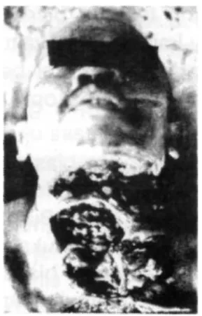 Gambar menunjukkan luka akibat kekerasan benda tajam berupa luka iris pada pipi serta leher  seorang korban pembunuhan menggunakan senjata tajam.
