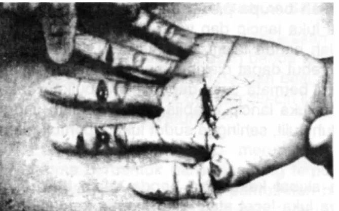 Gambar menunjukkan luka tangkis pada telapak tangan seorang korban pembunuhan  menggunakan senjata tajam.