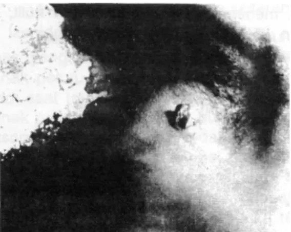 Gambar menunjukkan ujung anak peluru yang menembus keluar pada luka tembak keluar,  namun karena habis tenaganya lalu tersangkut pada kulit.