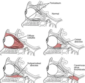 Gambar 3. Berbagai Inflamasi Orbita Factor risiko