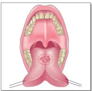 Gambar 15. Mandibulotomi median dengan ekstensi paralingual                                    (mandibular swing  operation)