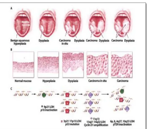 Gambar  6. (A) Gambaran klinis karsinoma lidah  (B) Gambaran histopatologi                          (C) Gambaran  molekul