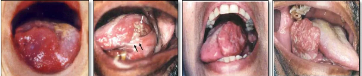 Gambar 7. Bentuk ulkus pada karsinoma lidah. 18 