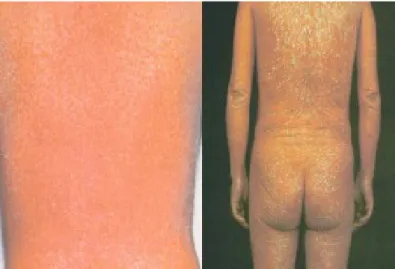 Gambar 2.5.2 Eritroderna karena Alergi Obat (gambar kiri); Red Man Syndrom (gambar kanan)